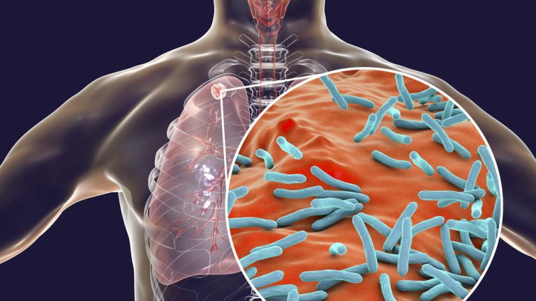 Kansas Faces Largest Tuberculosis Outbreak In US History