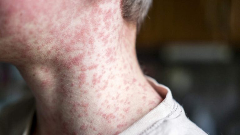Measles Cases Rising As Childhood Vaccination Rates Continue To Lag