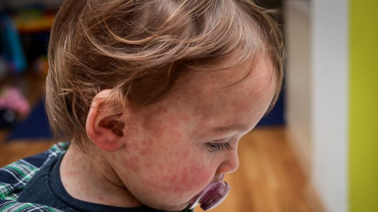 Infant Who Arrived at LAX Confirmed with Measles