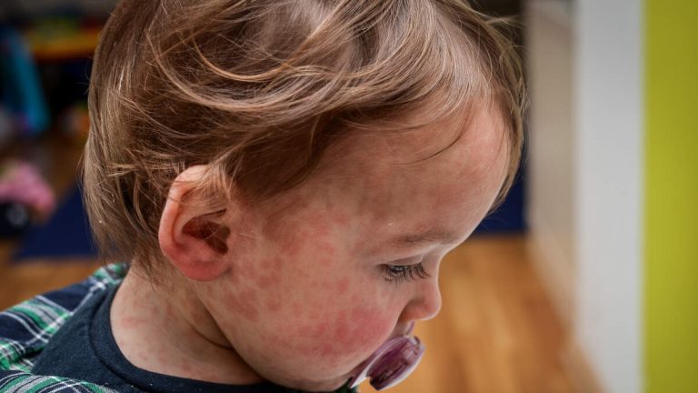 Texas Child Is First Measles Death In The US In A Decade