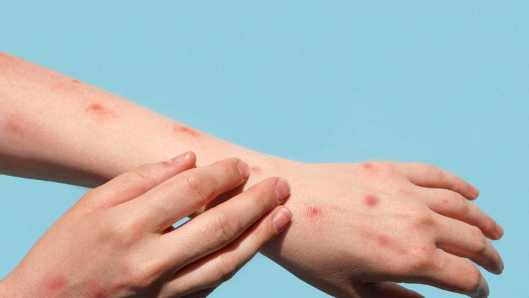 Long Beach Probes Severe Mpox Case in Local Resident
