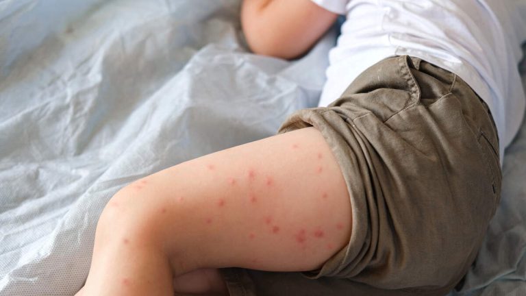 Over 150 Unvaccinated Students Forced To Quarantine After Measles Exposure