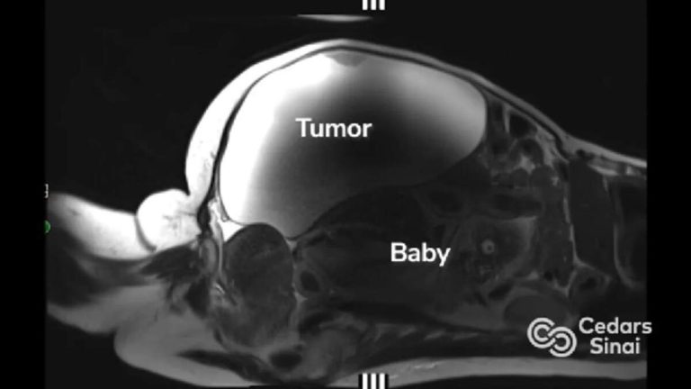 Woman Gives Birth After Discovering Pregnancy Just Days Before