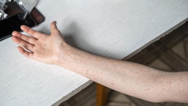 Measles Case Reported At US College As Outbreak Continues To Spread